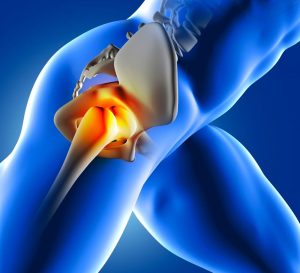 Osteonecrose da cabeça femoral 