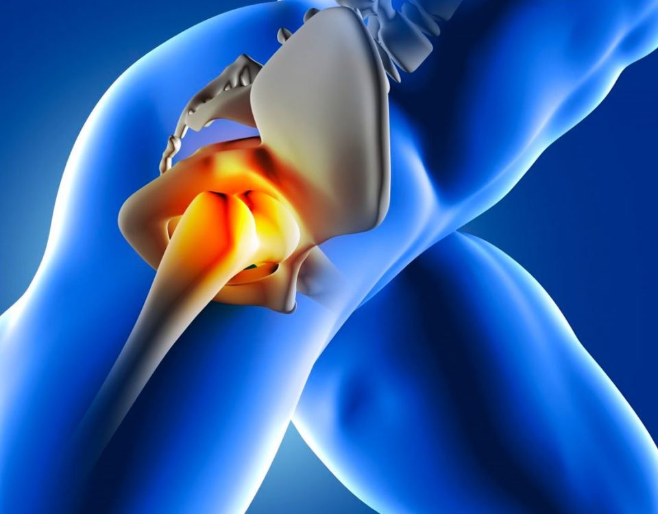 Osteonecrose da cabeça femoral