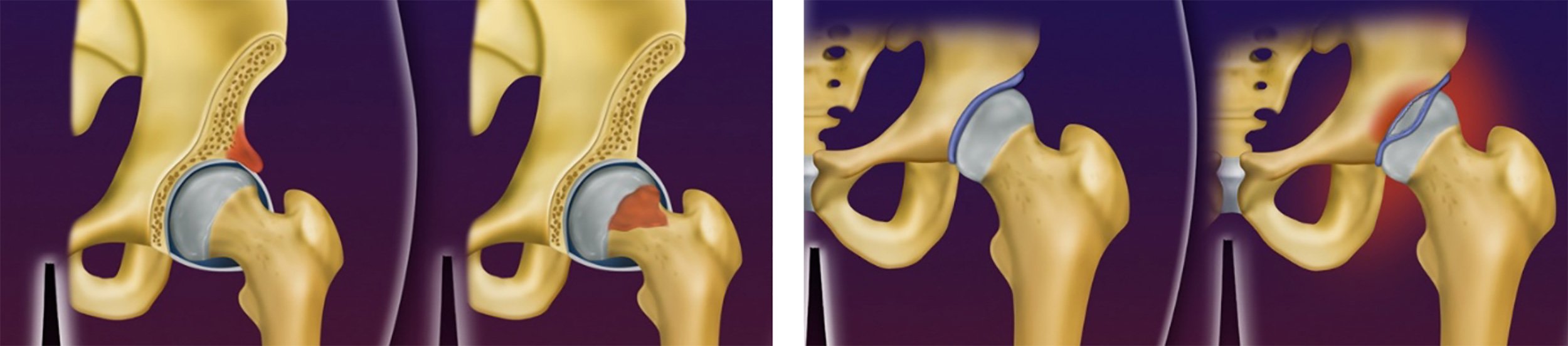 Impacto Fêmoro-Acetabular e Lesão Labral | Dr. Felipe Bessa