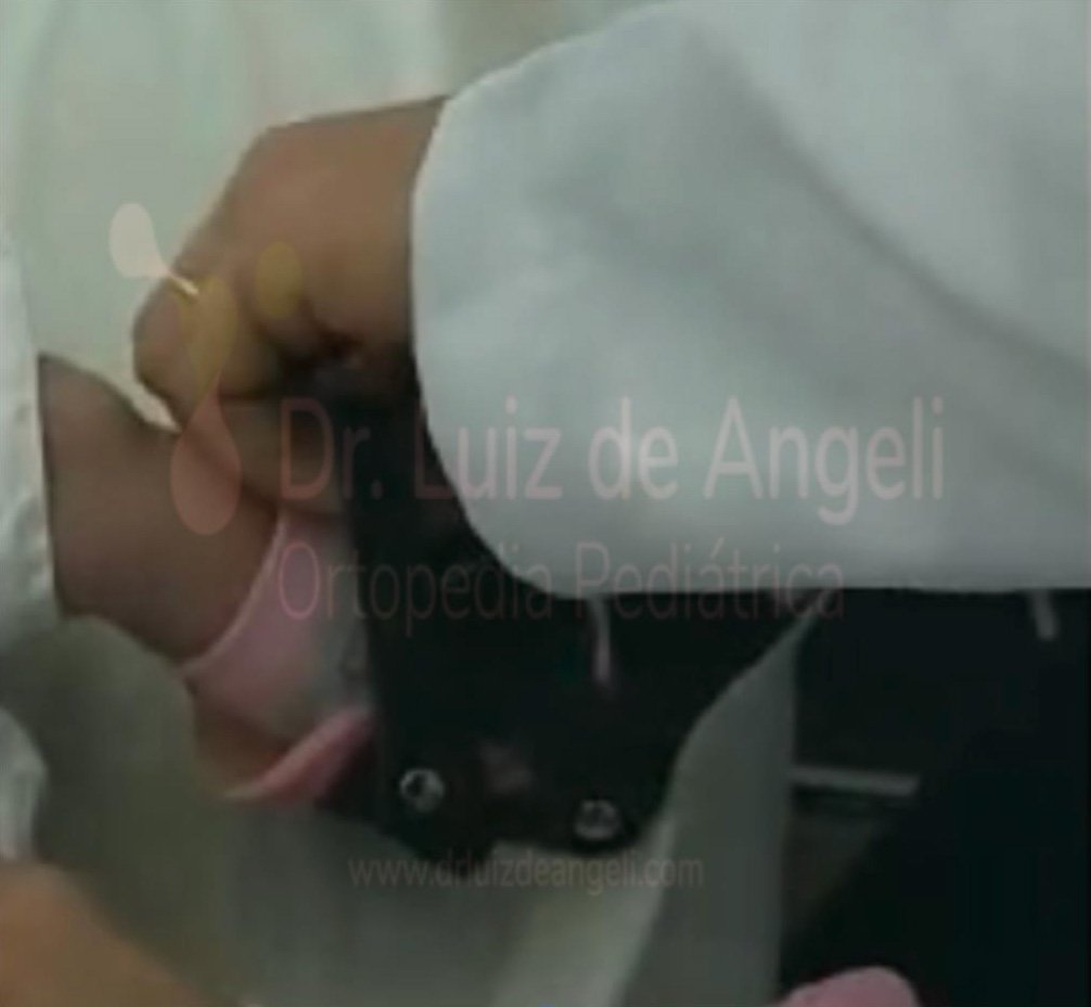 Órtese de Abdução | Dr. Luiz de Angeli
