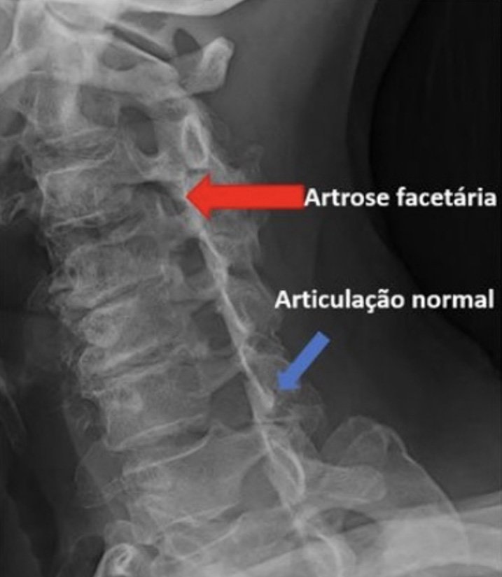 Artrose ou osteoartrite | Núcleo de Ortopedia