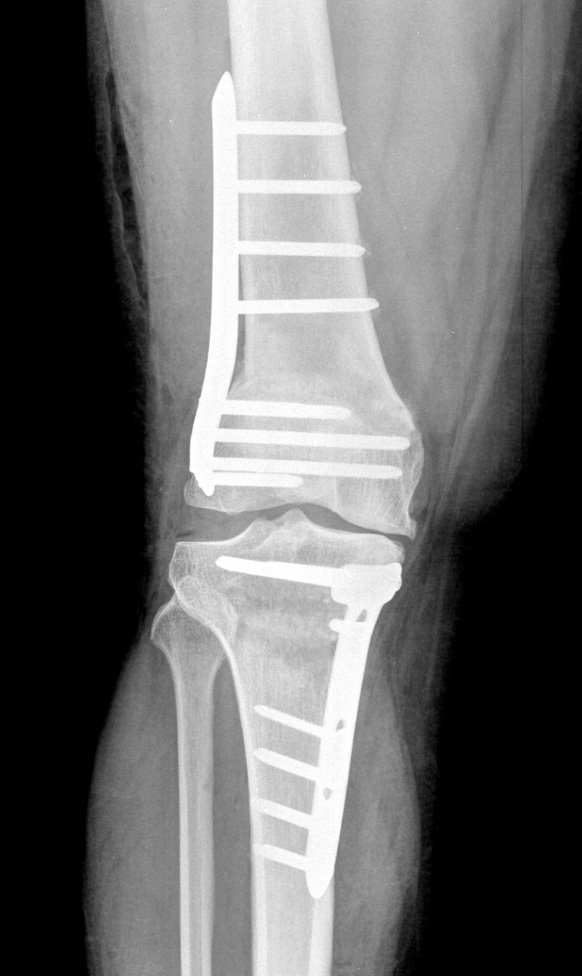 Osteotomia corretiva de deformidade no joelho | Núcleo de Ortopedia