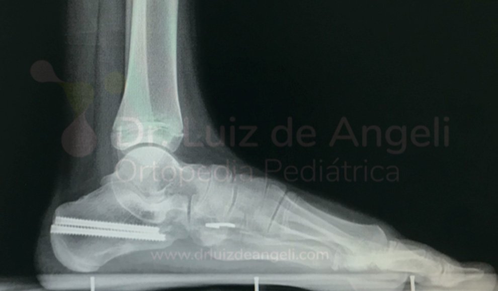 Osteotomias | Dr. Luiz de Angeli