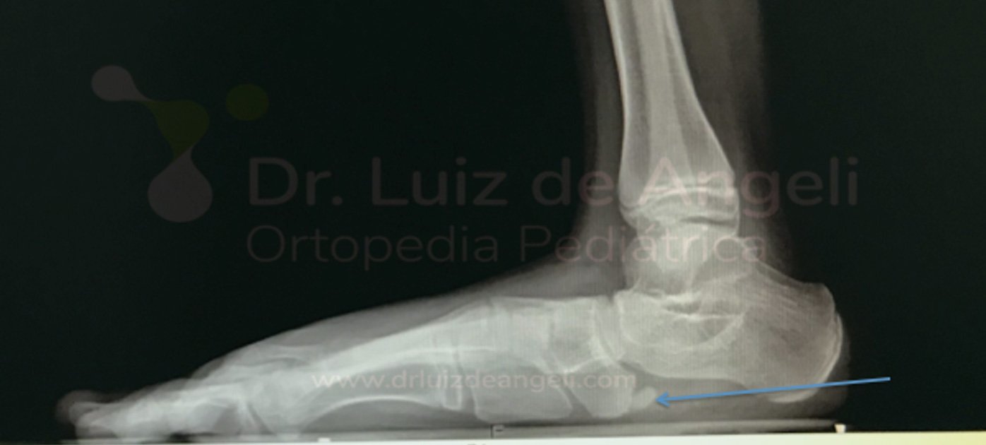 Ressecção do osso navicular acessório | Dr. Luiz de Angeli