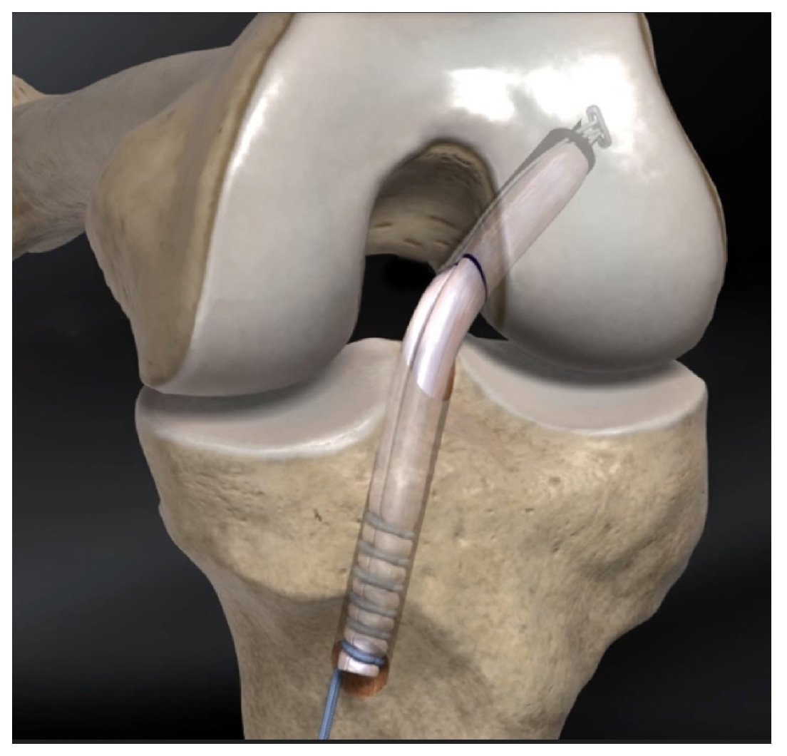 Reconstrução do ligamento cruzado anterior