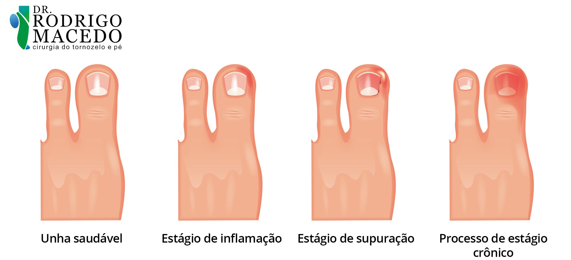 Unha encravada | Dr. Rodrigo Macedo