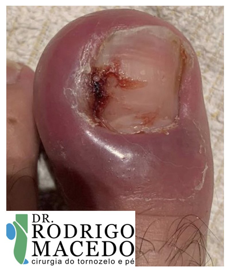 Unha encravada | Dr. Rodrigo Macedo