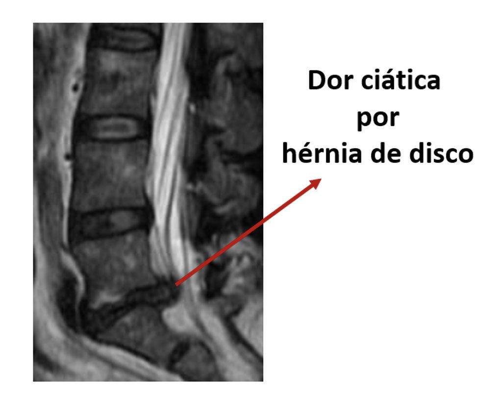 Dor ciática por hérnia de disco | Núcleo de Ortopedia