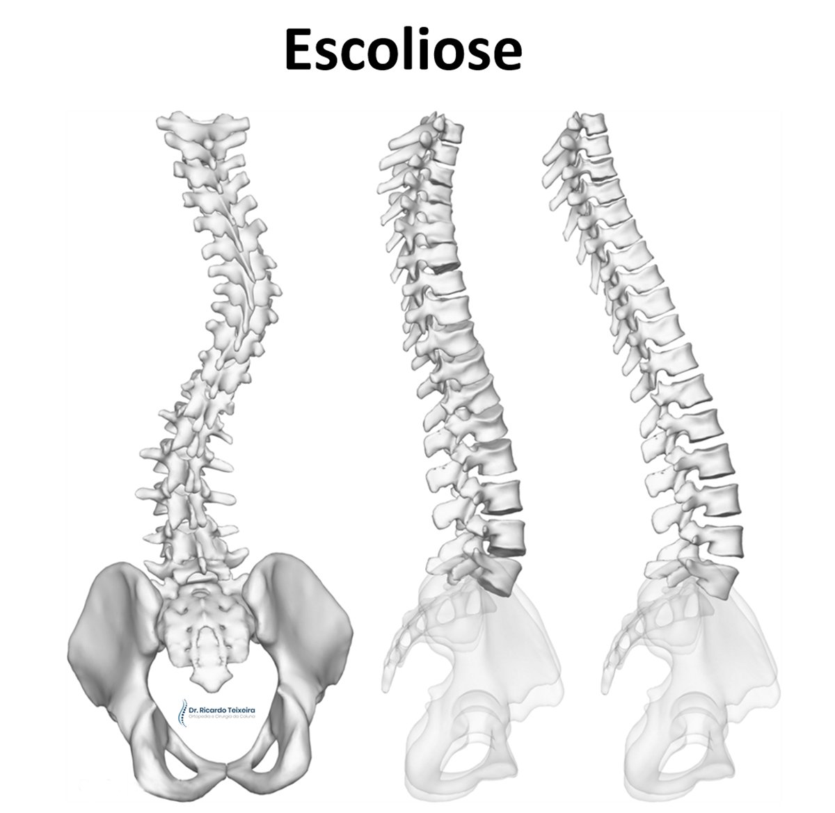 Escoliose | Dr. Ricardo Teixeira