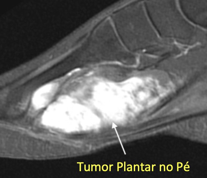 Tumor nos Pés | Núcleo de Ortopedia