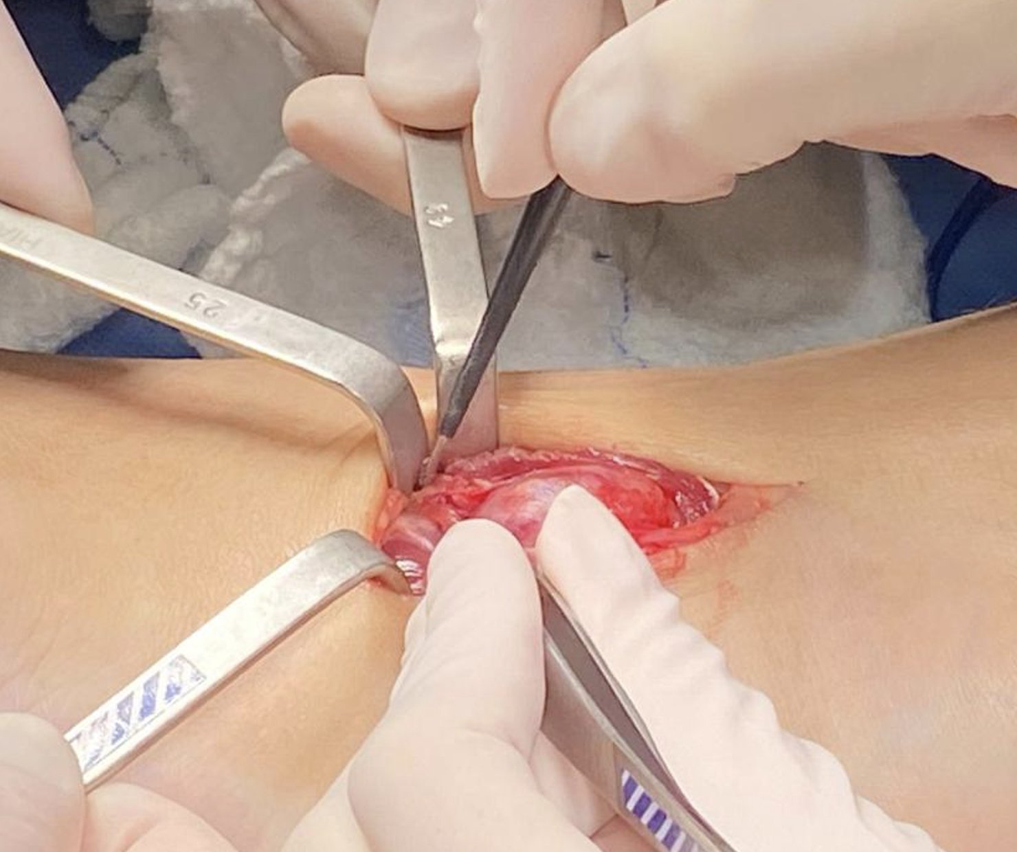 Tumoração vascular benigna | Dr. Rodrigo Macedo