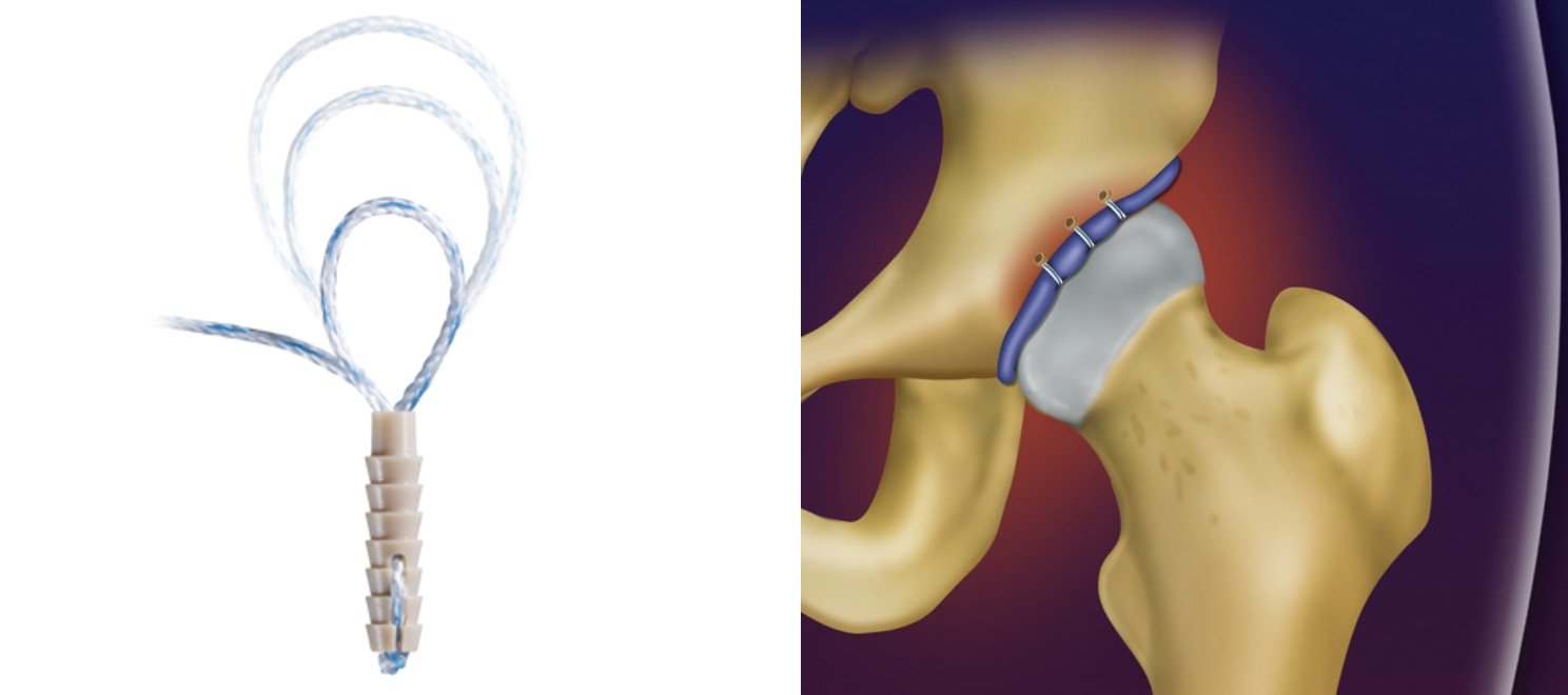 Lábio acetabular com lesão | Dr. Felipe Bessa