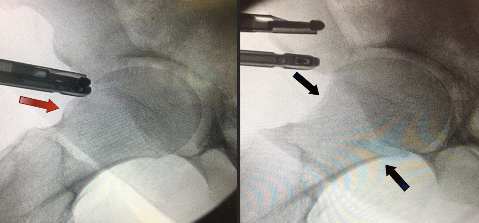 Impacto no quadril: lesão tipo CAME | Dr. Felipe Bessa