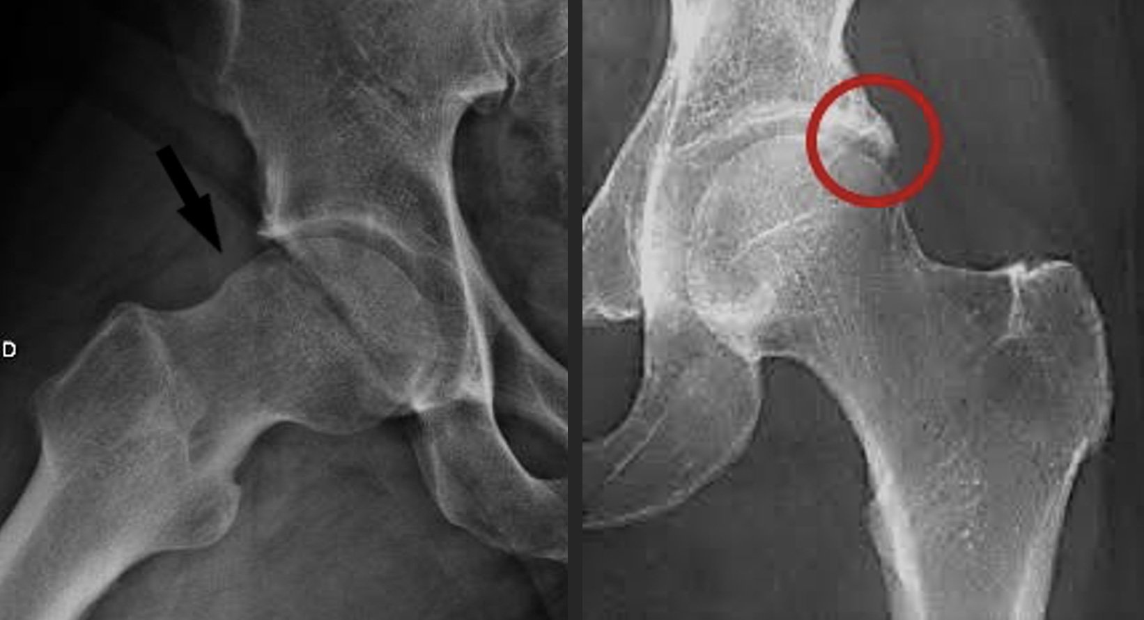 Impacto no quadril: proeminência óssea na borda do acetábulo | Dr. Felipe Bessa